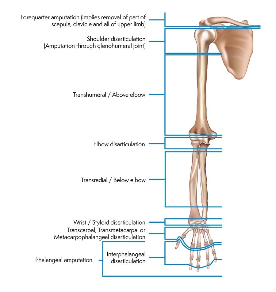 What Are My Prosthetic Options Based On My Amputation Level?